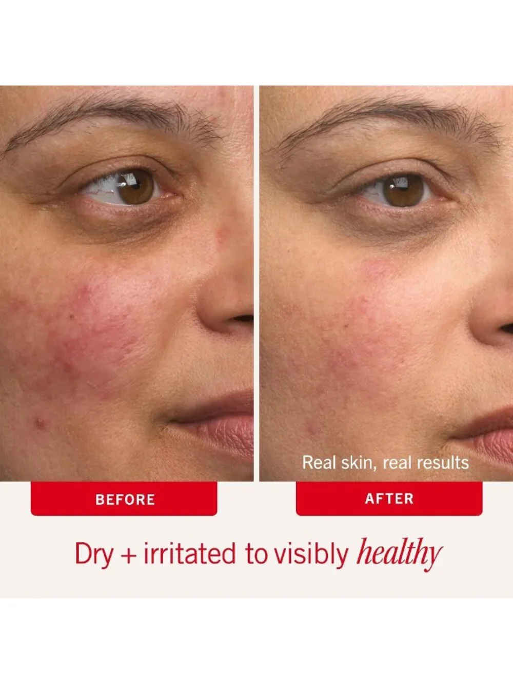 Intense Hydration Moisturizer for Face & Body - Eczema Relief, Fragrance-Free